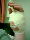 Belinda's hand post-op ... 28 Nov 07 